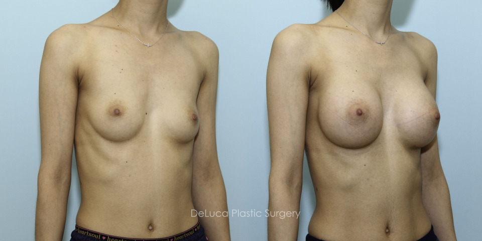 10510_breast augmentation_right45.jpg