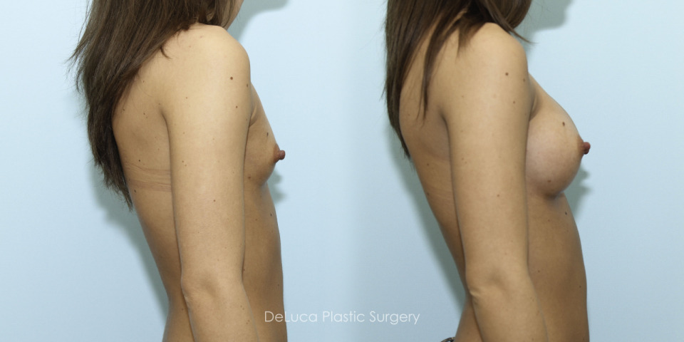 10536-breast-augmentation-2014-right.jpg