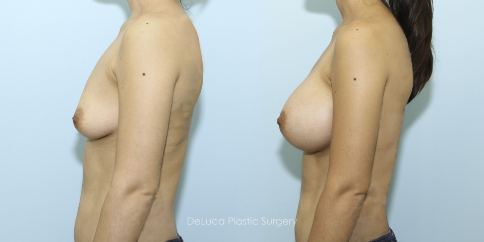 10546_breast augmentation_left.jpg