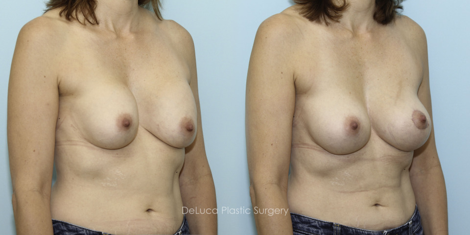 10592_breast augmentation_right45.jpg