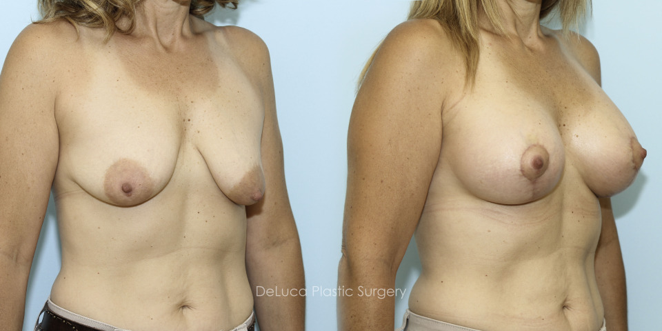 10614-breast-augmentation-2014-right45.jpg