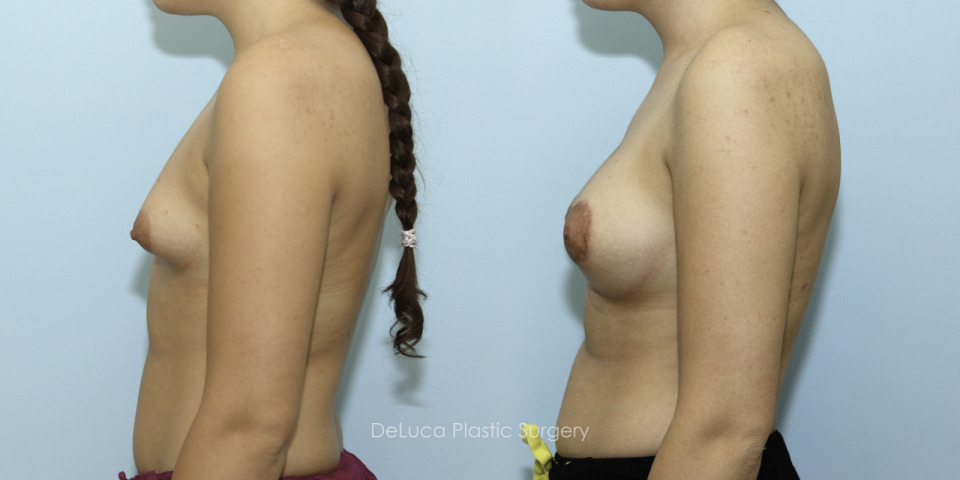10752 breast augmentation left.jpg