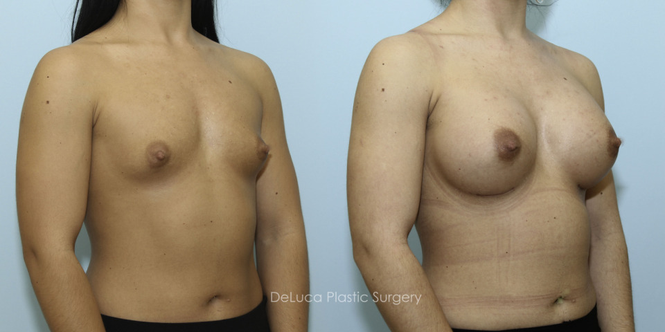 11324 breast augmentation right45.jpg