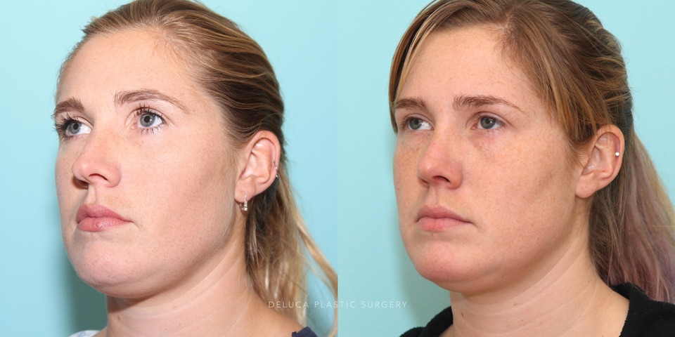 27 year old rhinoplasty with tip refinement and dorsal reductio_2.jpg