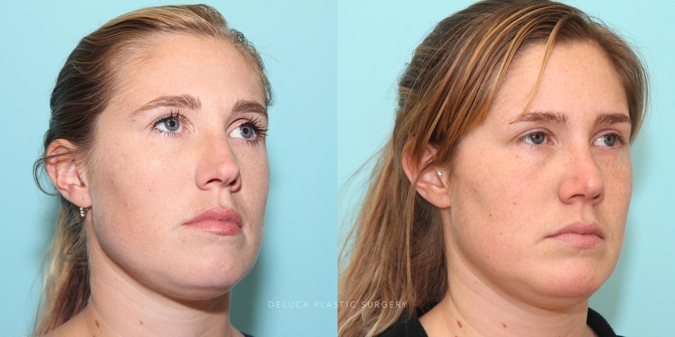 27 year old rhinoplasty with tip refinement and dorsal reductio_5.jpg