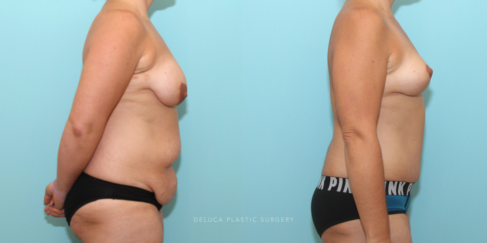 36 year old mommy makeover - breast lift and abdominoplasty no implants_5.jpg