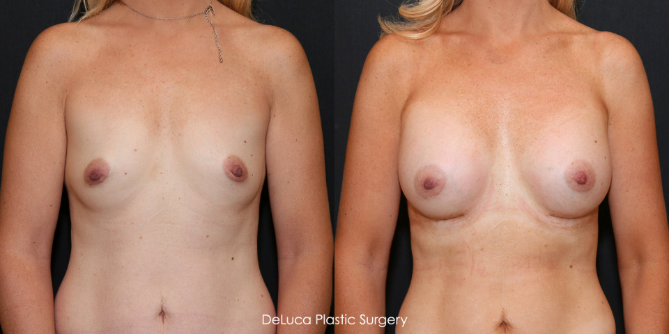 375cc-breast-implants-before-after-1.jpg