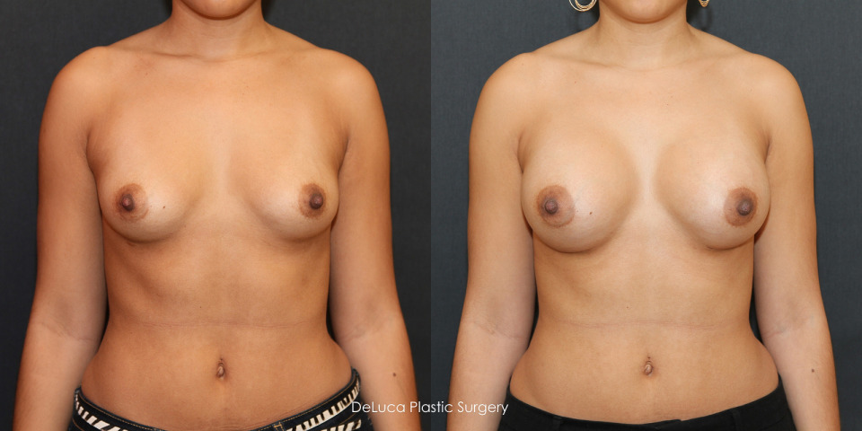 400cc-breast-augmentation-before-after-1b.jpg