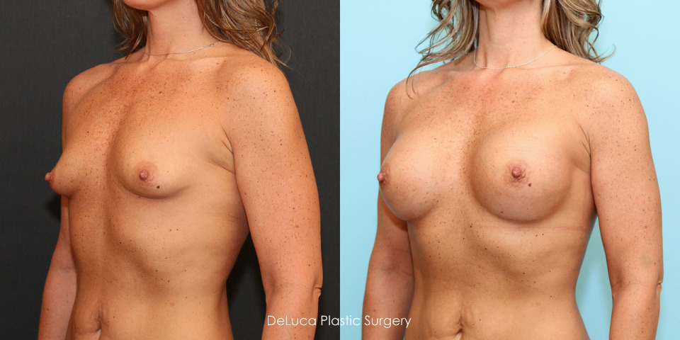 425cc-breast-augmentation-before-after-2a.jpg