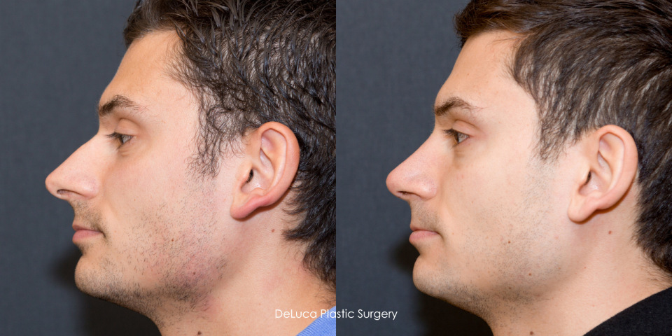 4861-male-rhinoplasty-before-after-5b.jpg
