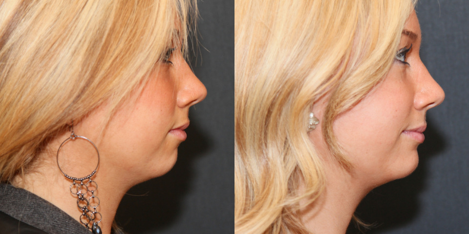 4964-chin-augmentation-before-after-4.jpg