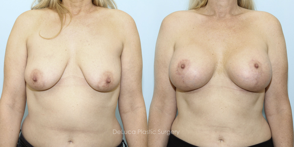5231-breast-augmentation-2014-center.jpg