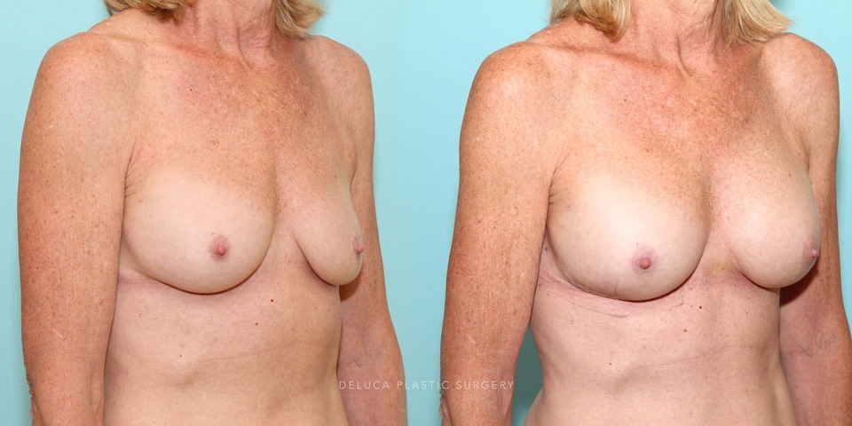 61 year old secondary asymmetric breast augmentation silicone implants_4.jpg