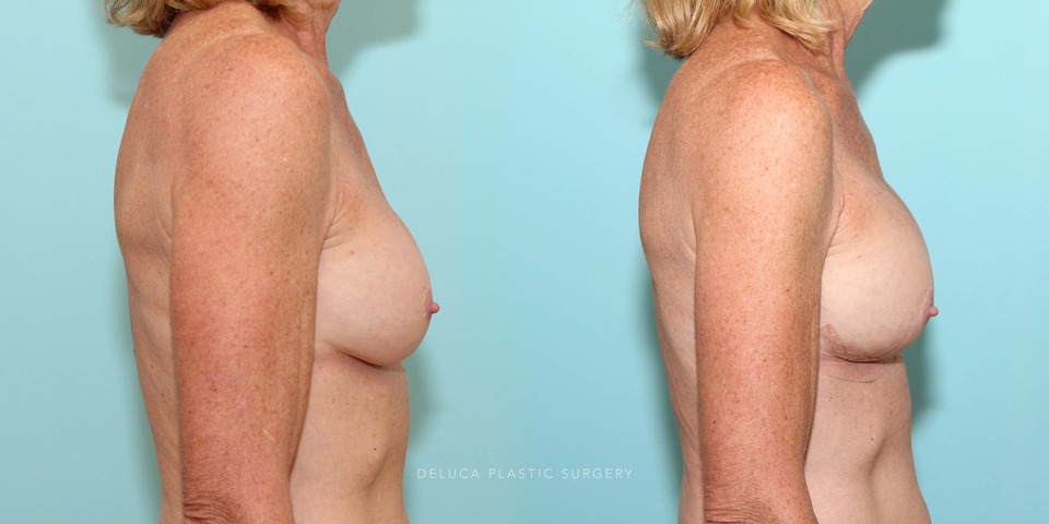 61 year old secondary asymmetric breast augmentation silicone implants_5.jpg