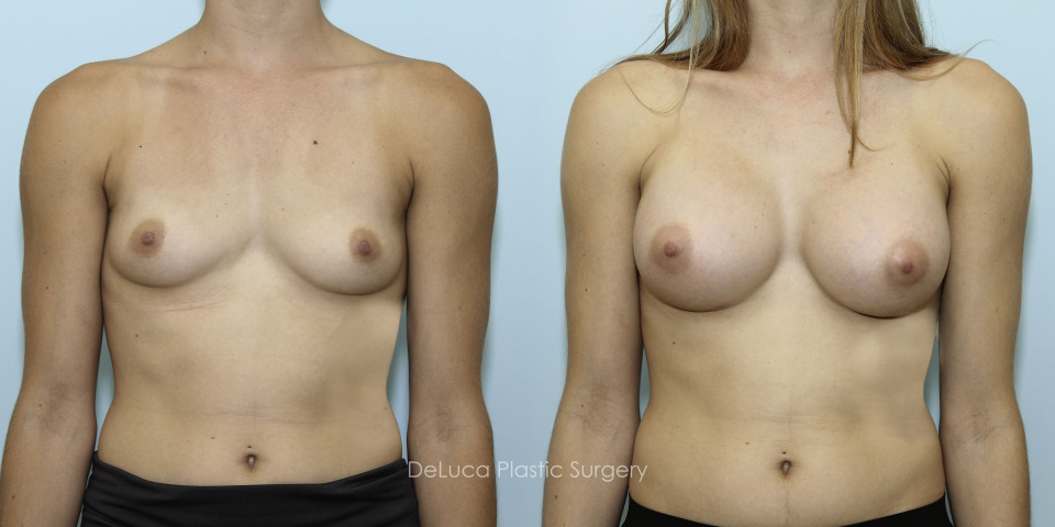 8102_breast augmentation_center.jpg