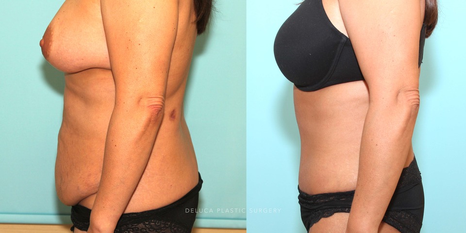 abdominoplasty and liposuction of the abdomen and flanks_1.jpg