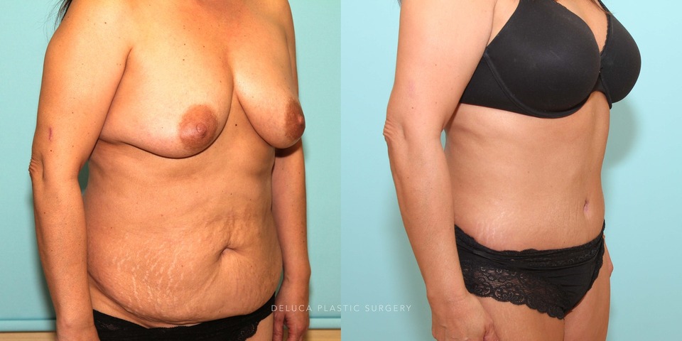 abdominoplasty and liposuction of the abdomen and flanks_4.jpg