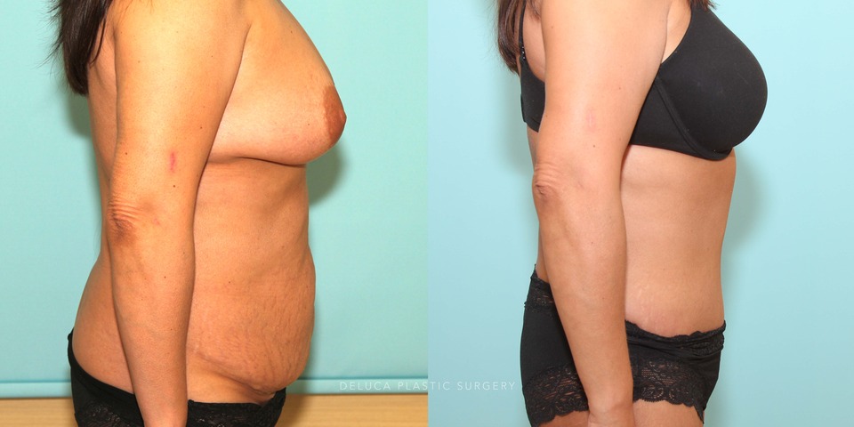 abdominoplasty and liposuction of the abdomen and flanks_5.jpg