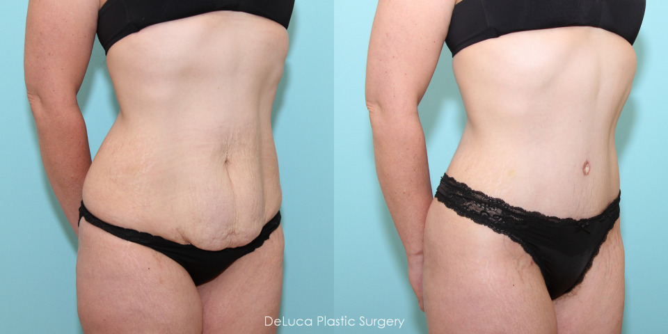 abdominoplasty-before-after-4.jpg