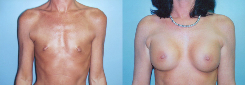 albany-breast-implants-before-after-1a-1200x420.jpg