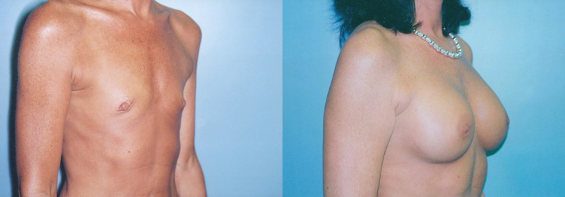 albany-breast-implants-before-after-2-1200x420.jpg