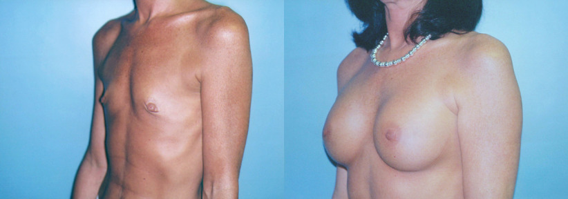 albany-breast-implants-before-after3-1200x420.jpg