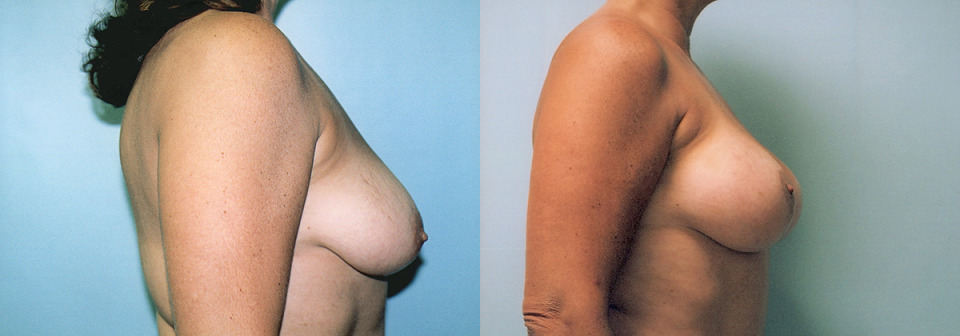 albany-breast-lift-augmentation-before-after-4a-1200x420.jpg