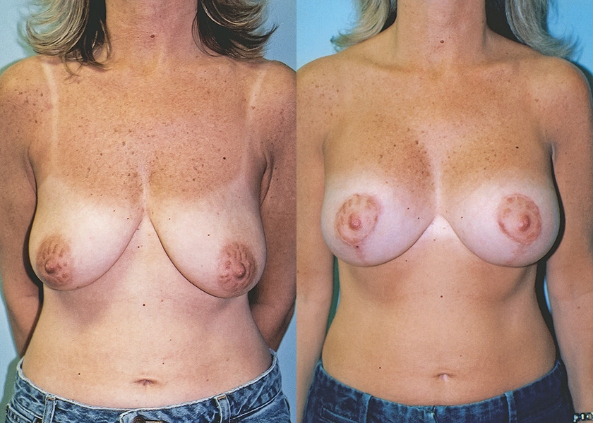 albany-breast-lift-photo-before-after-1.jpg