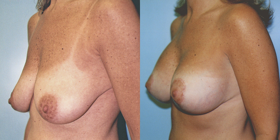 albany-breast-lift-photo-before-after-2.jpg