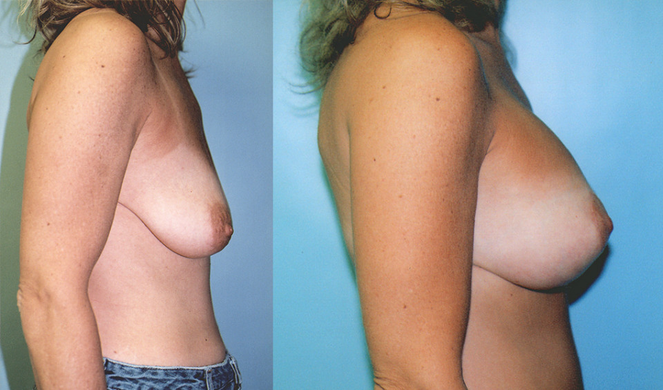 albany-breast-lift-photo-before-after-4.jpg