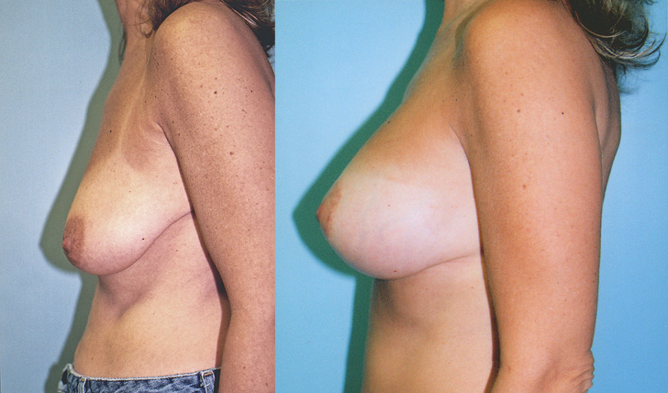 albany-breast-lift-photo-before-after-5.jpg