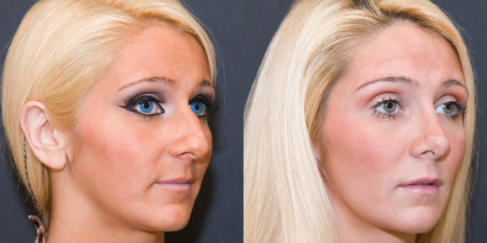 albany-nose-rhinoplasty-before-after-2sq.jpg
