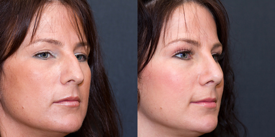albany-nose-rhinoplasty-deluca-before-after-2c.jpg