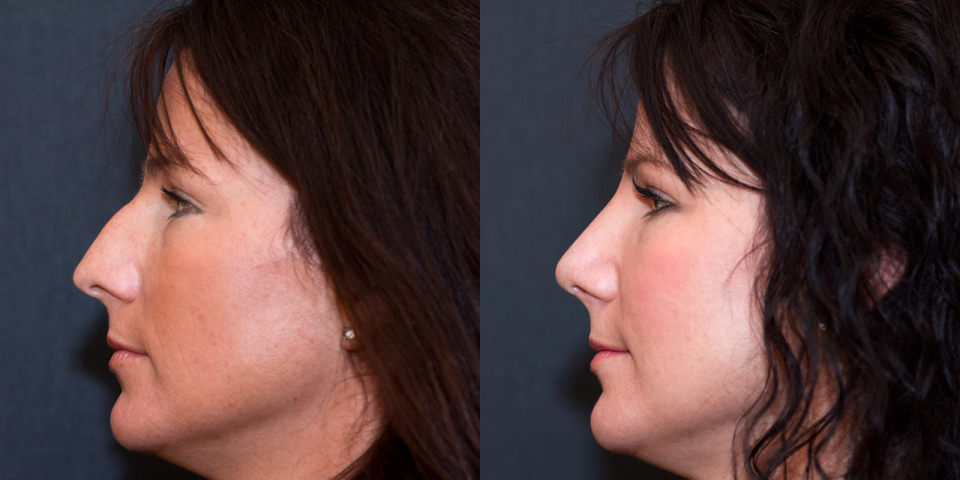albany-nose-rhinoplasty-deluca-before-after-4.jpg