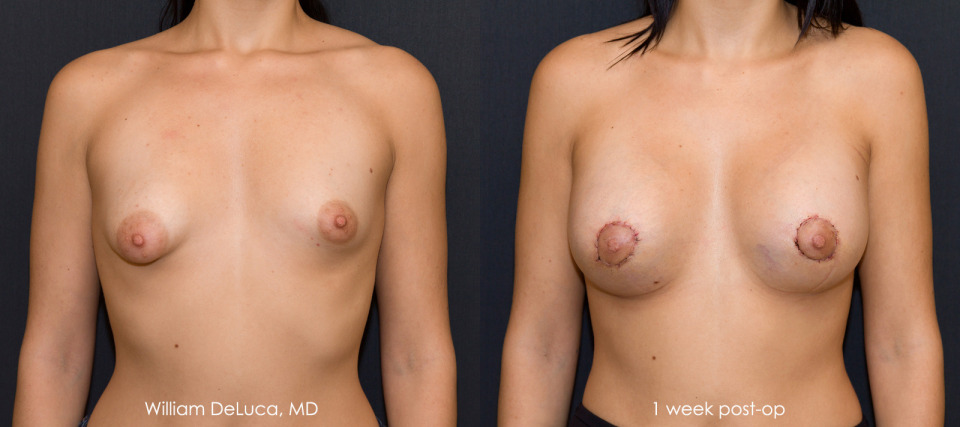 albany-ny-tuberous-breast-correction-before-after-1a.jpg
