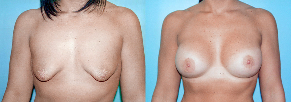 albany-tuberous-breast-correction-before-after-1b.jpg