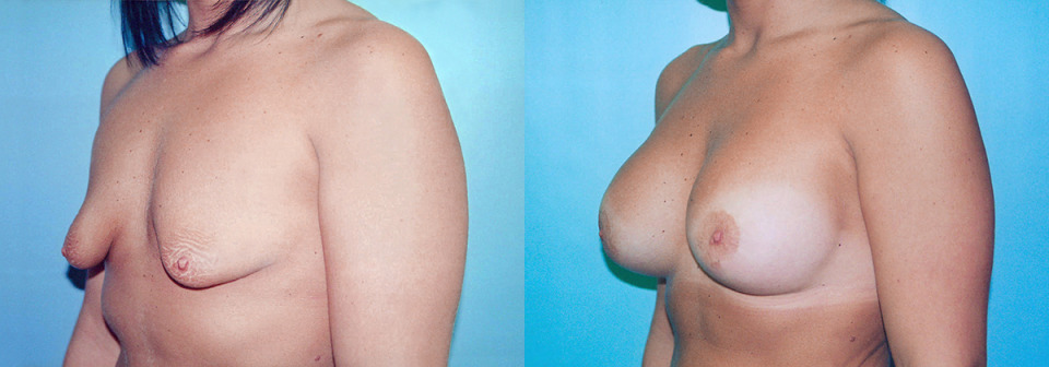 albany-tuberous-breast-correction-before-after-3a.jpg