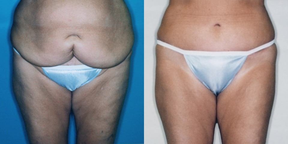albany-tummy-tuck-before-after-1.jpg