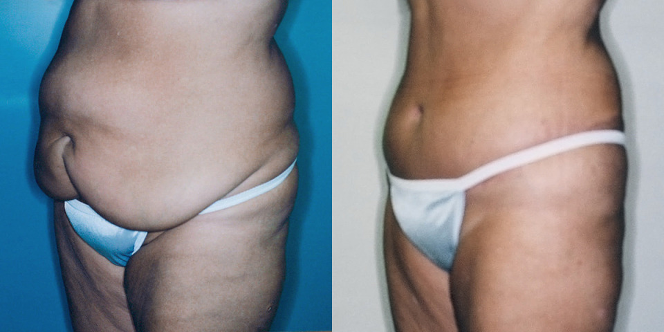 albany-tummy-tuck-before-after-3.jpg