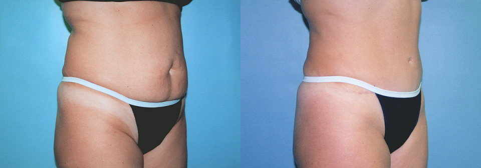 albany-tummy-tuck-before-after-photo-3.jpg