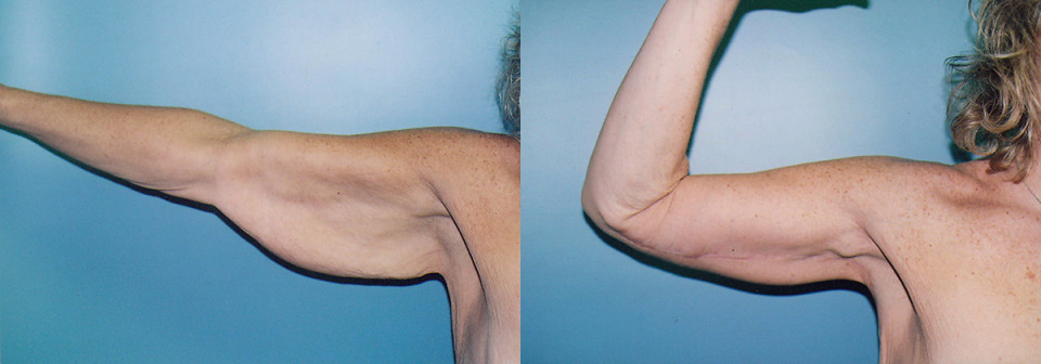 arm-lift-albany-before-after-2-1200x420.jpg
