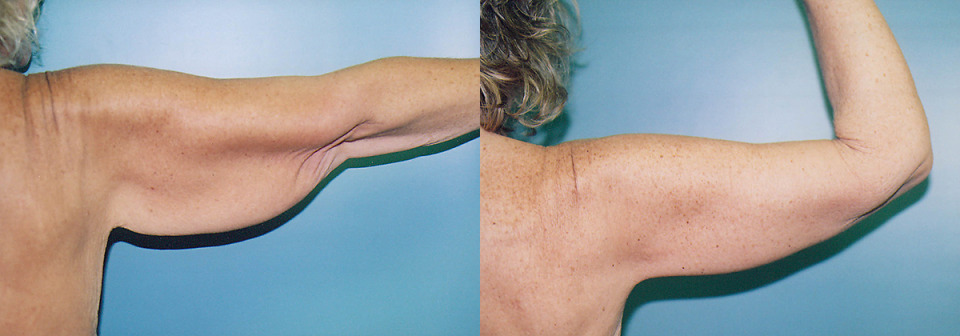 arm-lift-albany-before-after-3-1200x420.jpg
