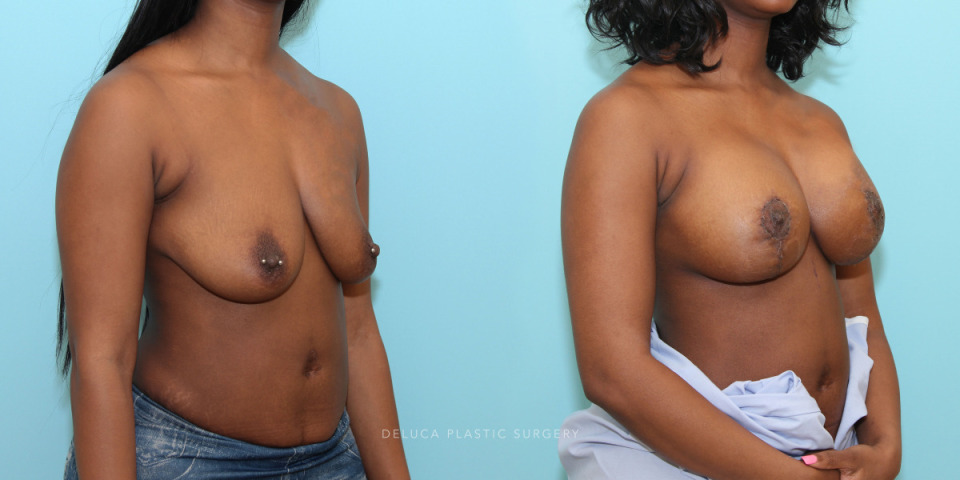 augment mastopexy with 300cc moderate plus silicone implants_2.jpg