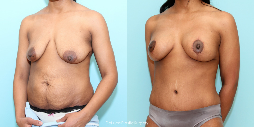 augmentation-mastopexy-200cc-before-after-2.jpg