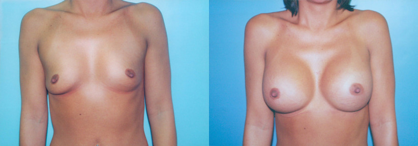 breast-augment-before-1-1200x420.jpg