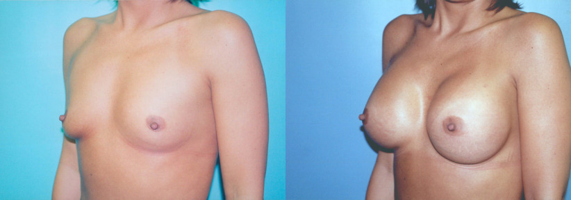 breast-augment-before-3-1200x420.jpg