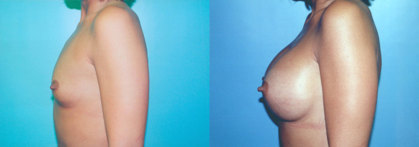 breast-augment-before-after-4-1200x420.jpg