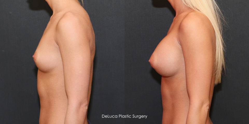 breast-augmentation-300cc-implants-before-after-3a-5060.jpg
