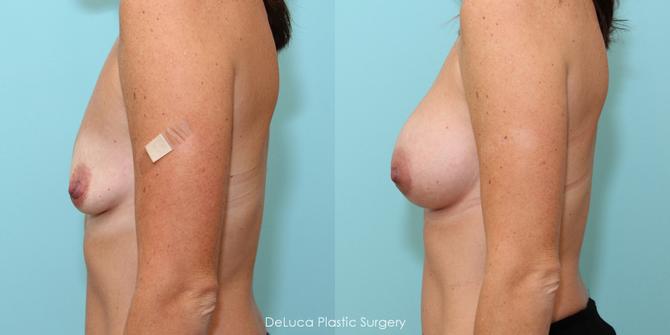 breast-augmentation-325cc-silicone-3.jpg