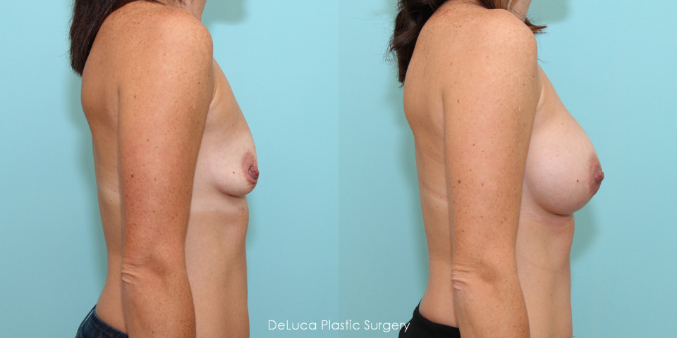 breast-augmentation-325cc-silicone-5.jpg